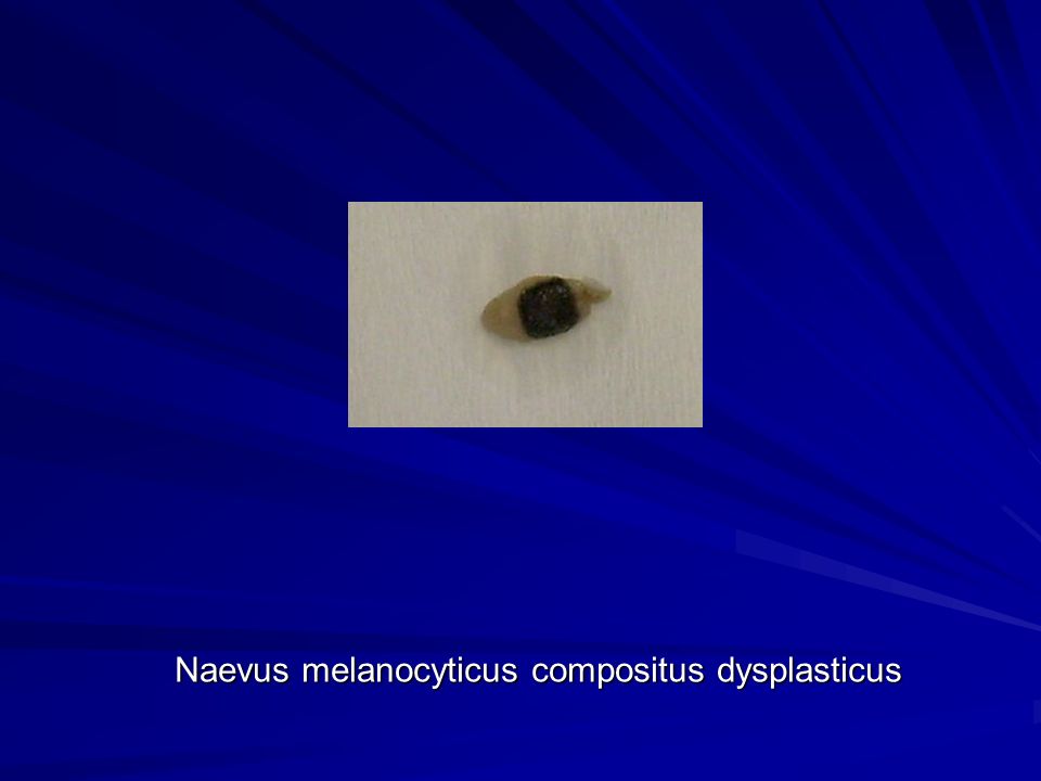 Naevus melanocyticus compositus dysplasticus