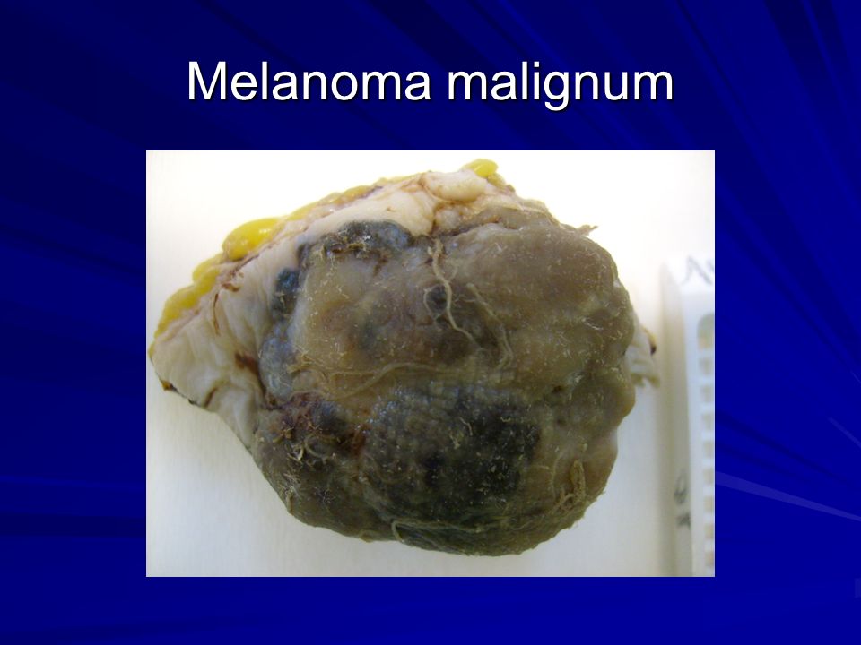 Melanoma malignum