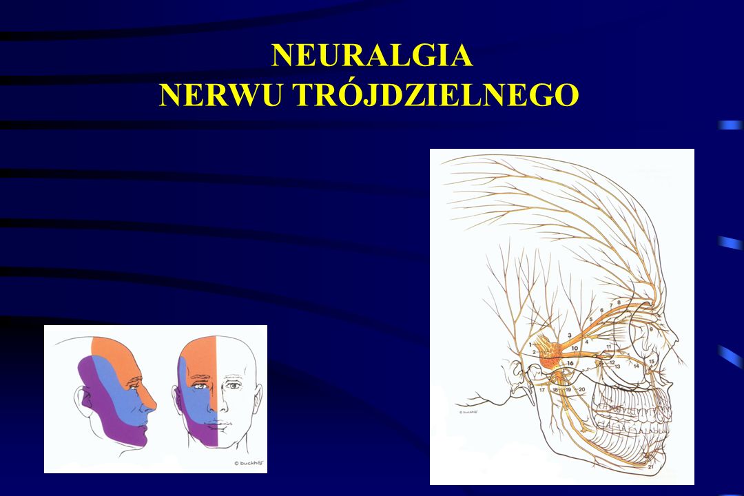 NEURALGIA NERWU TRÓJDZIELNEGO