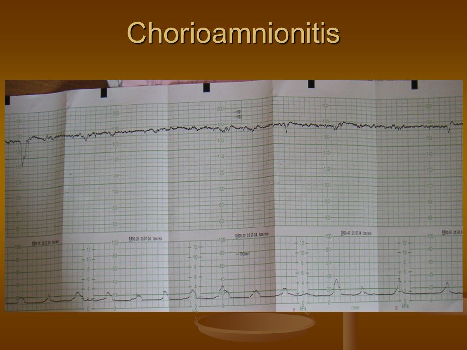 Chorioamnionitis