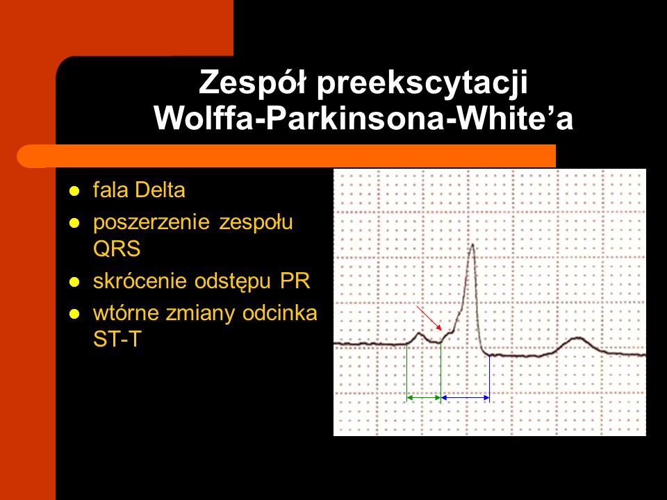 Zespół preekscytacji Wolffa-Parkinsona-White’a
