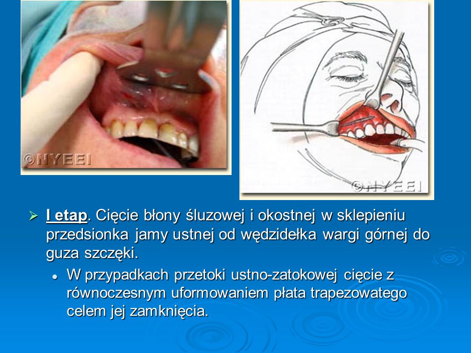 I etap. Cięcie błony śluzowej i okostnej w sklepieniu przedsionka jamy ustnej od wędzidełka wargi górnej do guza szczęki.