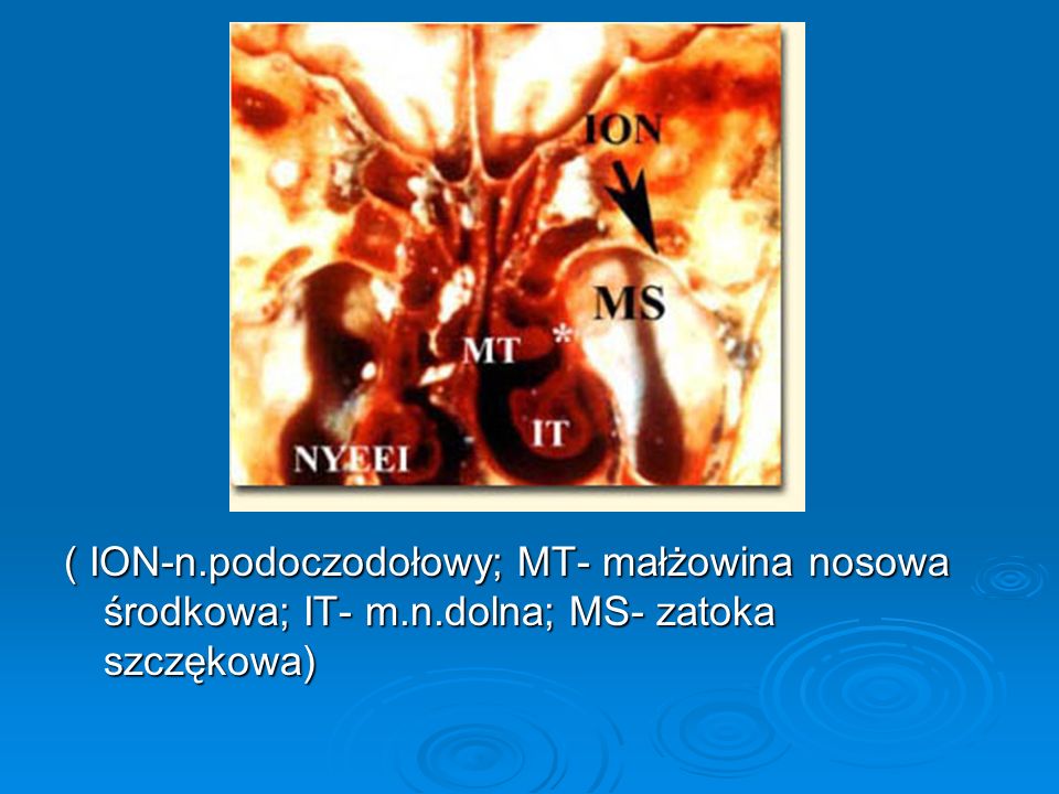 ( ION-n. podoczodołowy; MT- małżowina nosowa środkowa; IT- m. n