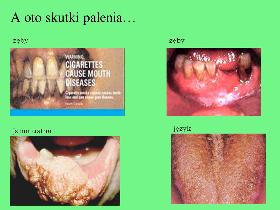 A oto skutki palenia… zęby zęby język jama ustna